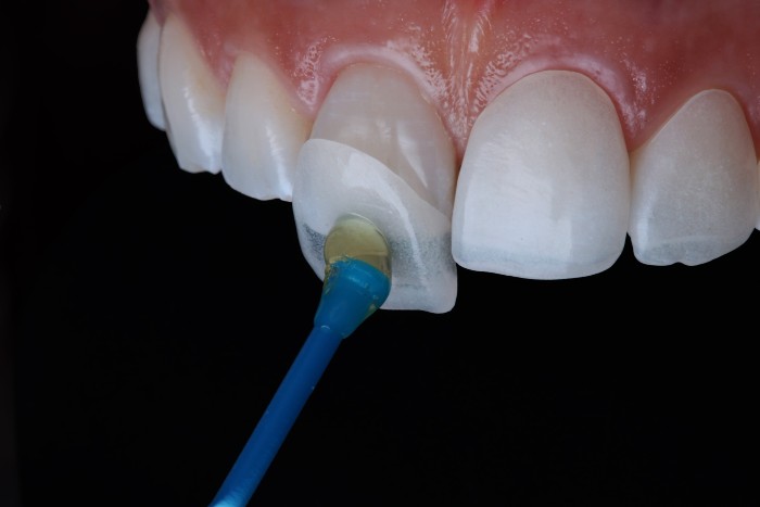 https://dental.harbors.in/wp-content/uploads/2023/04/dental-veneers1.jpg