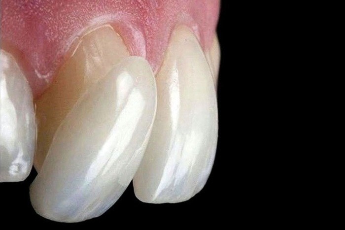 https://dental.harbors.in/wp-content/uploads/2023/04/dental-veneers2.jpg