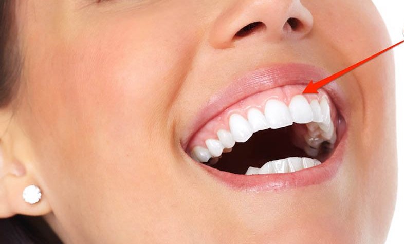 https://dental.harbors.in/wp-content/uploads/2023/04/gummysmile1.jpg