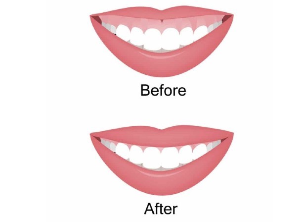 https://dental.harbors.in/wp-content/uploads/2023/04/gummysmile2.jpg