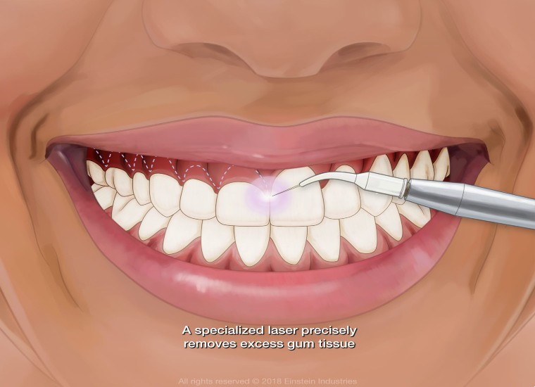 https://dental.harbors.in/wp-content/uploads/2023/04/gummysmile3.jpg