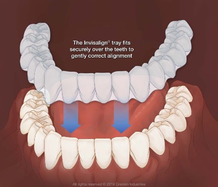 https://dental.harbors.in/wp-content/uploads/2023/04/invasilign1.jpg
