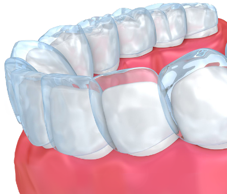 https://dental.harbors.in/wp-content/uploads/2023/04/invasilign3.png