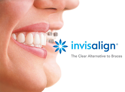 https://dental.harbors.in/wp-content/uploads/2023/04/invisalign.jpg