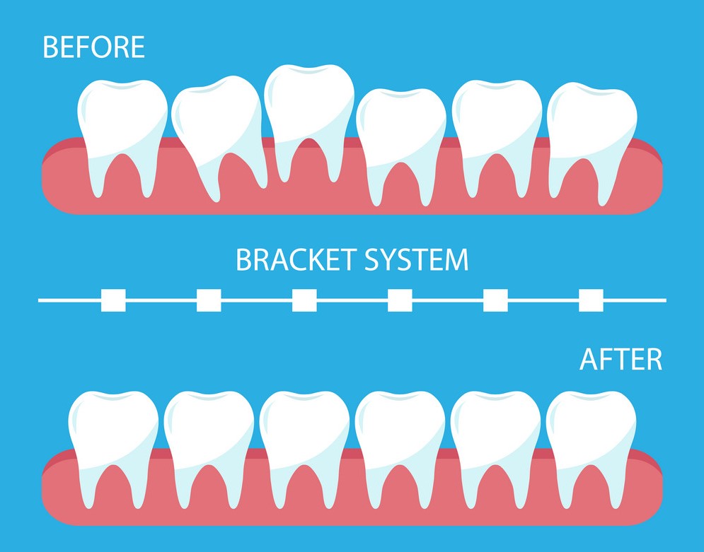 The process of correction of teeth with orthopedic braces. Stages of teeth alignment, before and after correction. Poster bracket system, flat style