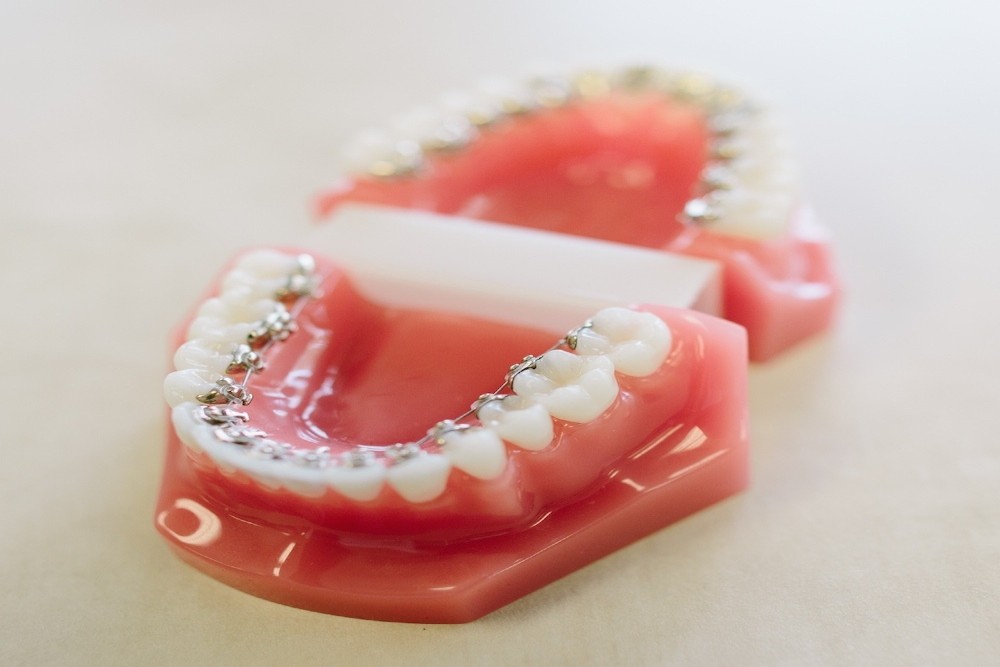 https://dental.harbors.in/wp-content/uploads/2023/06/Dental-Braces4.jpg