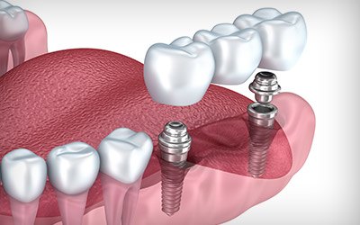 https://dental.harbors.in/wp-content/uploads/2023/06/Dental-Implant4.jpg