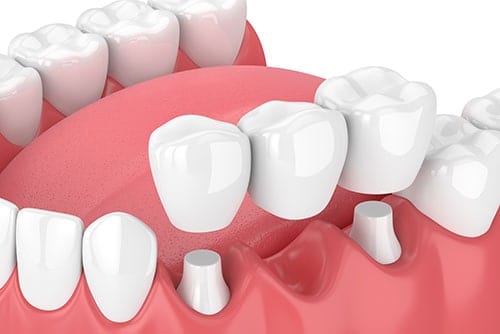 https://dental.harbors.in/wp-content/uploads/2023/06/DentalCrown2.jpg
