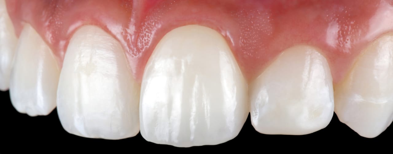 https://dental.harbors.in/wp-content/uploads/2023/06/DentalCrown4.jpg