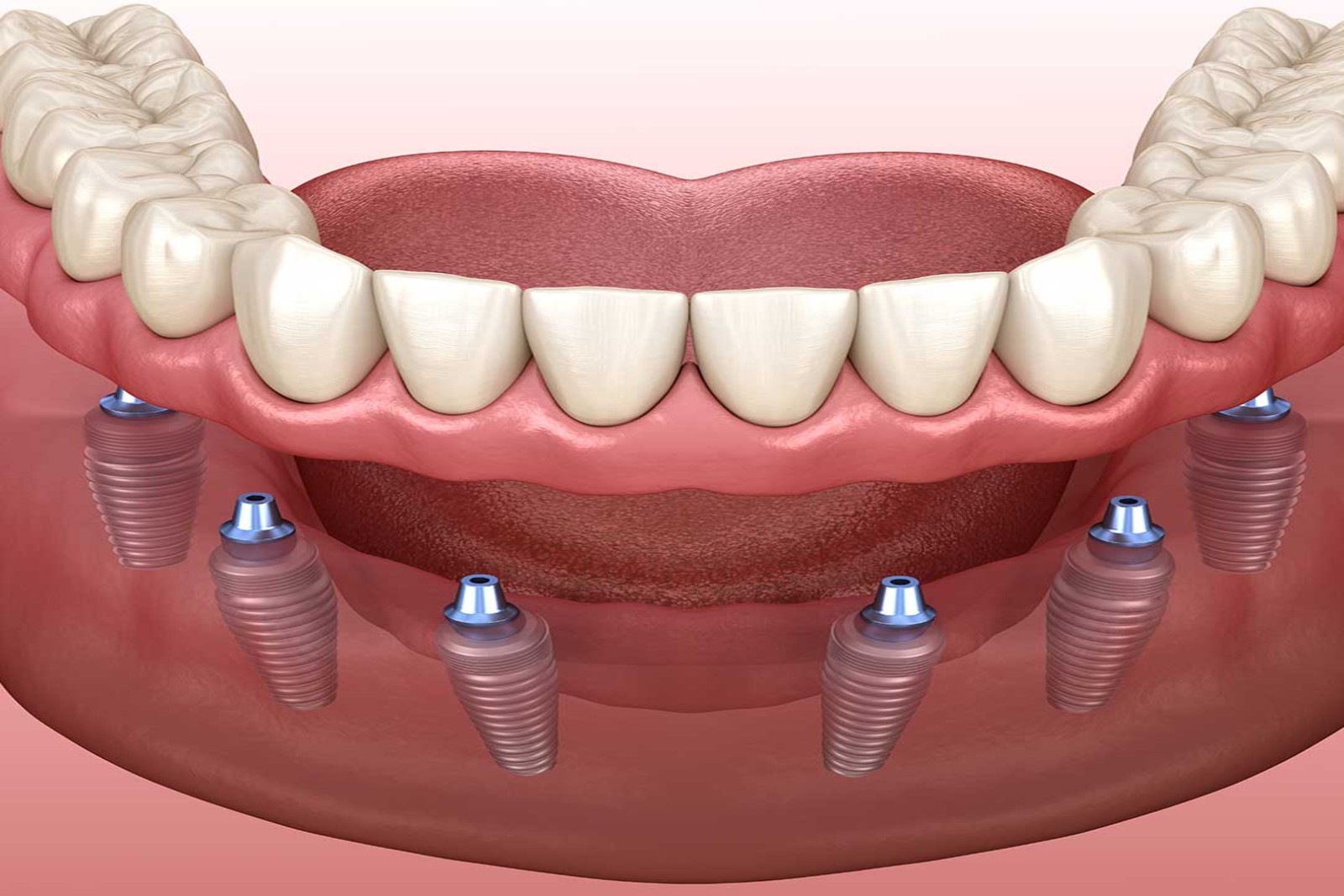 https://dental.harbors.in/wp-content/uploads/2023/06/Denture9.jpg