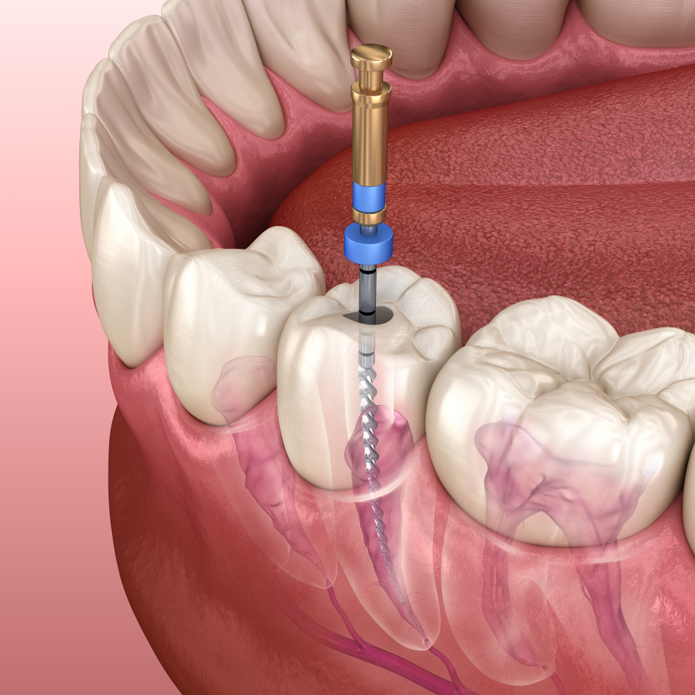 https://dental.harbors.in/wp-content/uploads/2023/06/Root-Canal-Treatment1.png