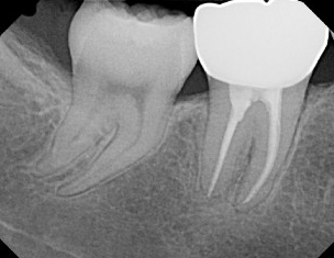 https://dental.harbors.in/wp-content/uploads/2023/06/Root-Canal-Treatment4.jpg