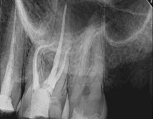 https://dental.harbors.in/wp-content/uploads/2023/06/Root-Canal-Treatment5.jpg