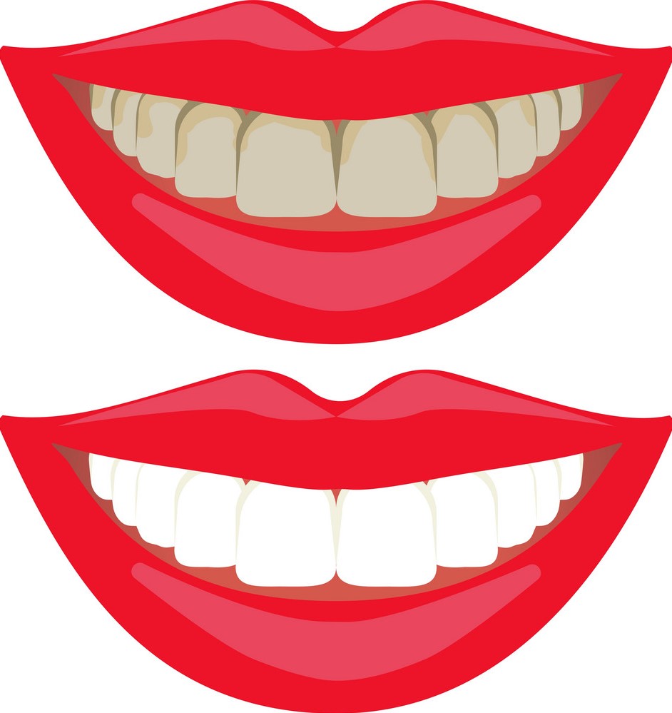 https://dental.harbors.in/wp-content/uploads/2023/06/TeethWhitening3.jpg