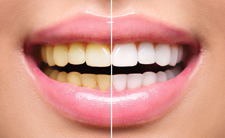 https://dental.harbors.in/wp-content/uploads/2023/06/TeethWhitening4.jpg