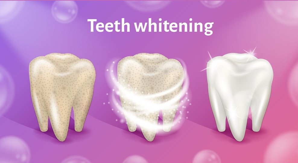 Teeth whitening in realistic 3d vector illustration. Teeth cleaning concept. Tooth before, in process and after whitening. First tooth is dirty, other is clean and white.