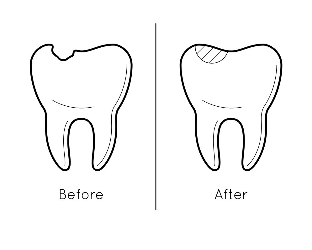 https://dental.harbors.in/wp-content/uploads/2023/06/Tooth-colour-filling1.jpg