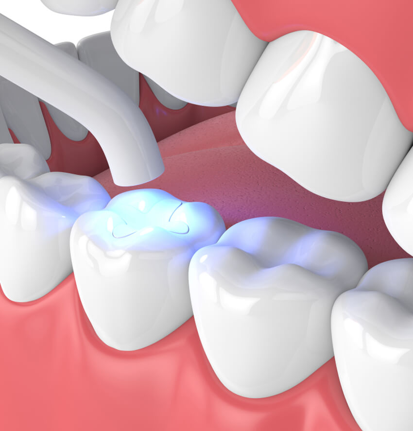 https://dental.harbors.in/wp-content/uploads/2023/06/Tooth-colour-filling2.jpg