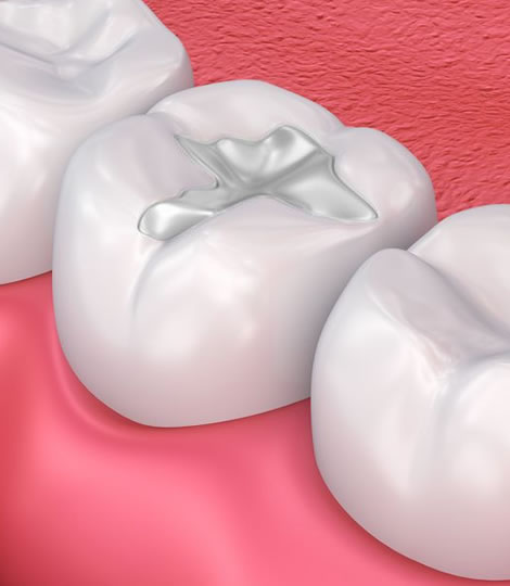 https://dental.harbors.in/wp-content/uploads/2023/06/Tooth-colour-filling3.jpg