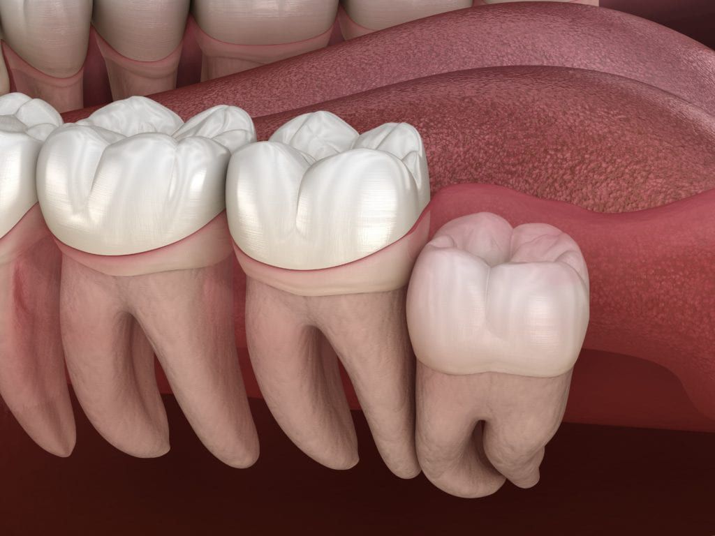 https://dental.harbors.in/wp-content/uploads/2023/06/Wisdom-Toom-Removal1.jpg