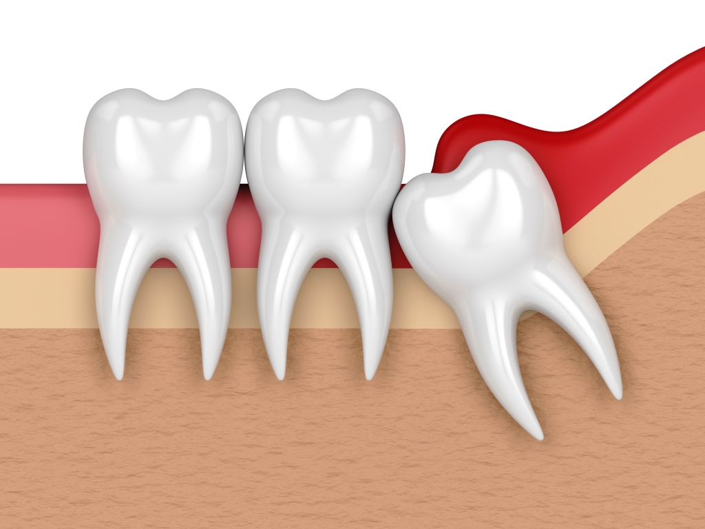 https://dental.harbors.in/wp-content/uploads/2023/06/Wisdom-Toom-Removal2.jpg