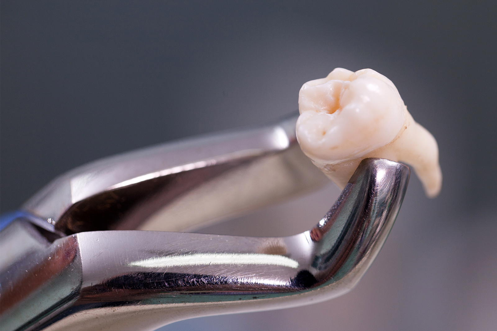 https://dental.harbors.in/wp-content/uploads/2023/06/Wisdom-Toom-Removal3.jpg