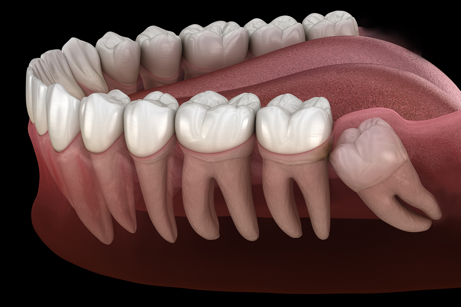 https://dental.harbors.in/wp-content/uploads/2023/06/Wisdom-Toom-Removal4.jpg