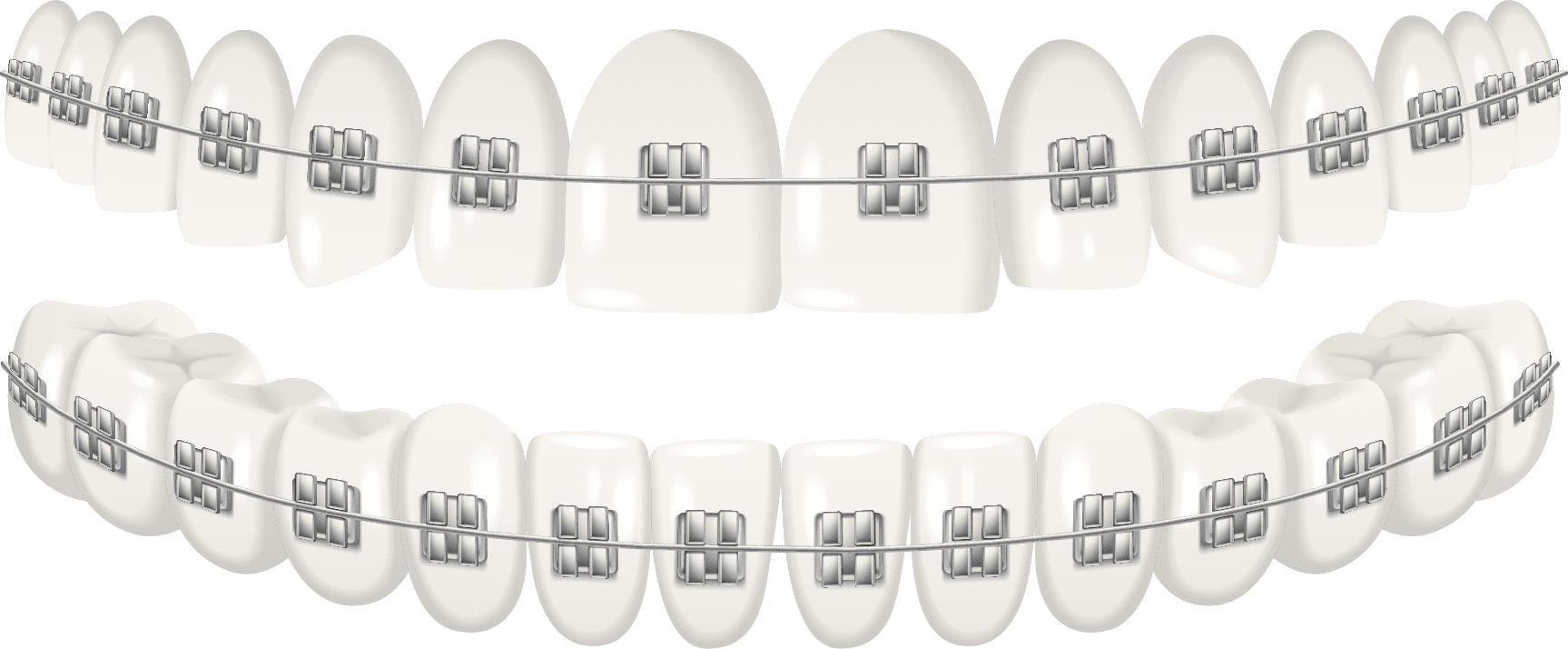 https://dental.harbors.in/wp-content/uploads/2024/01/Dental-braces-2.png