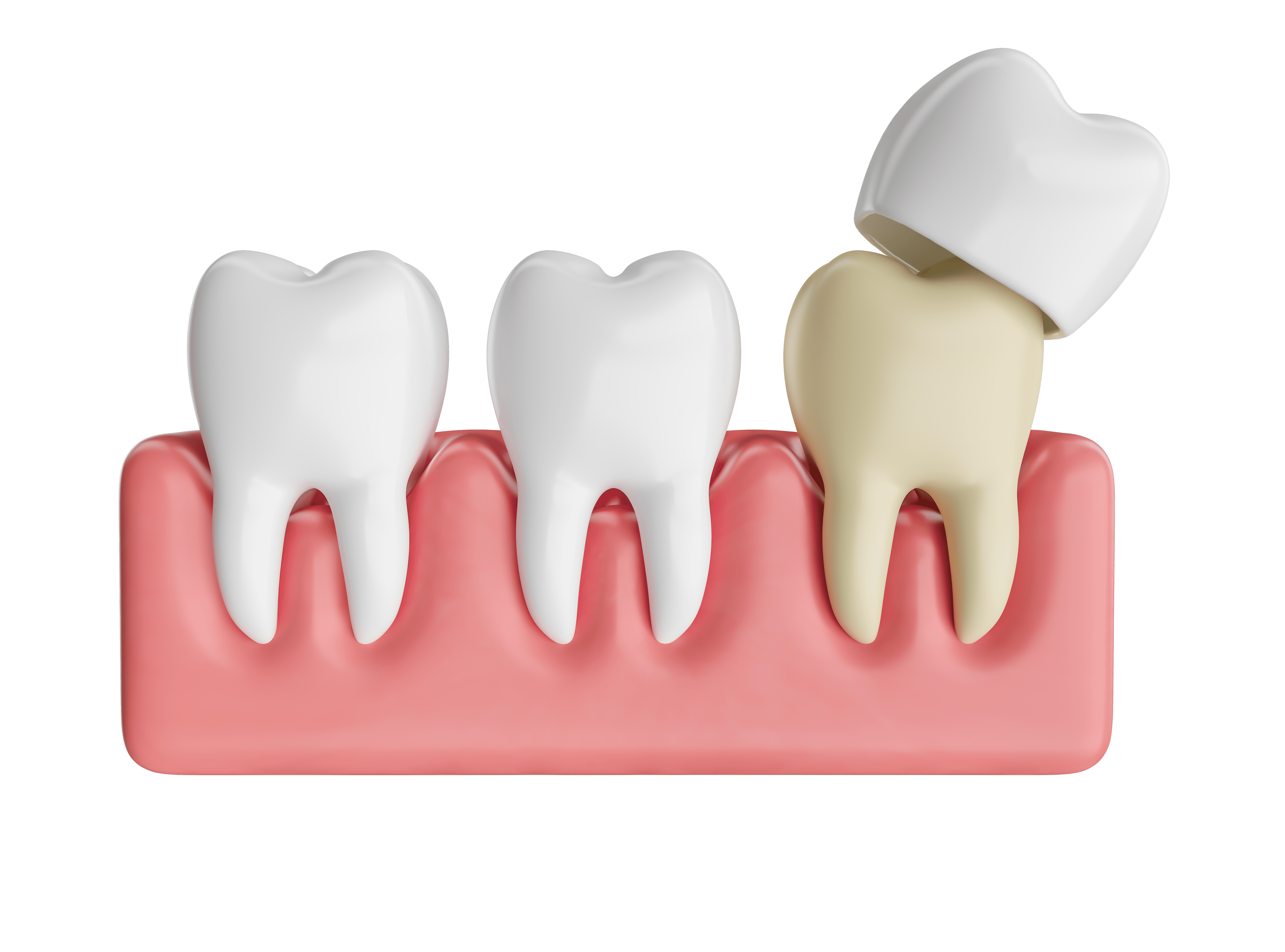 https://dental.harbors.in/wp-content/uploads/2024/01/crown-bridge.png