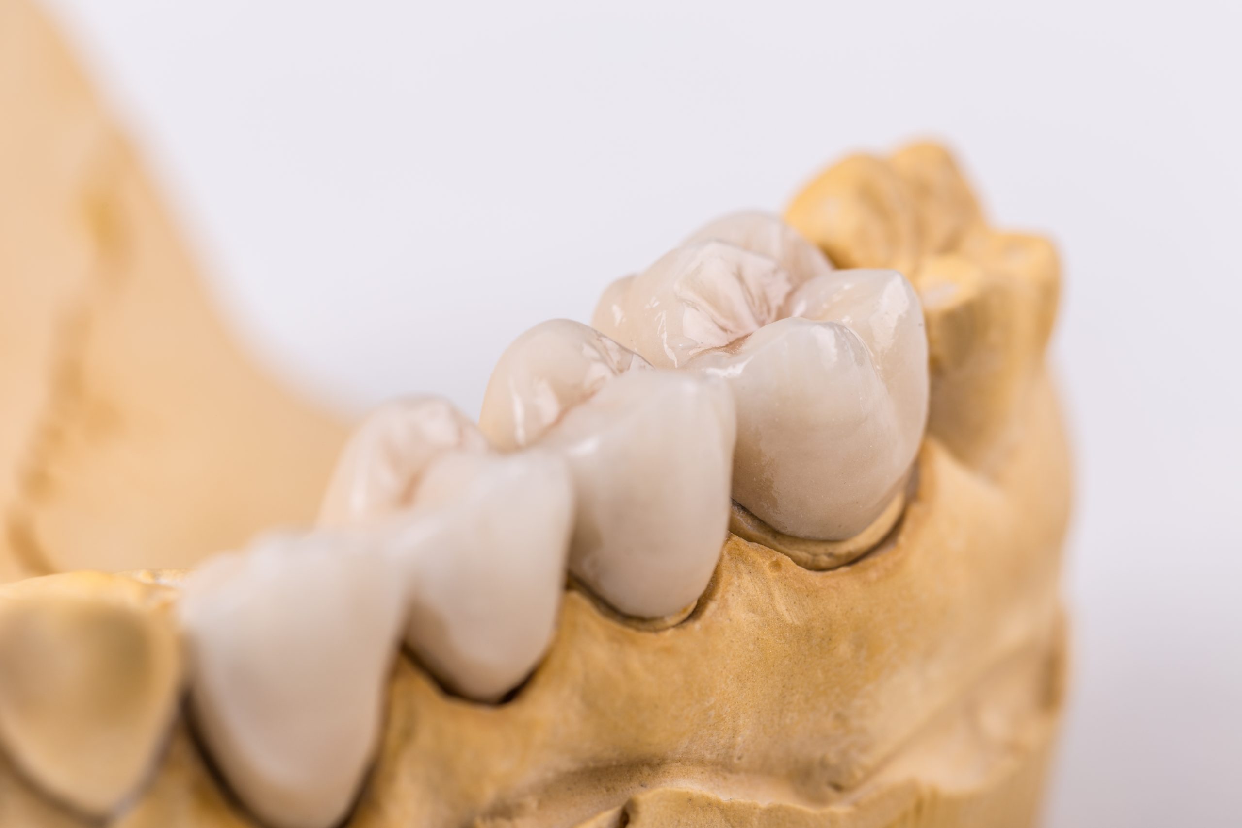 Denture made of ceramics located on plaster model
